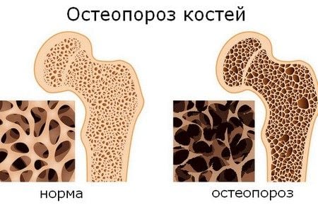 Кости с остеопорозом и нормальные кости